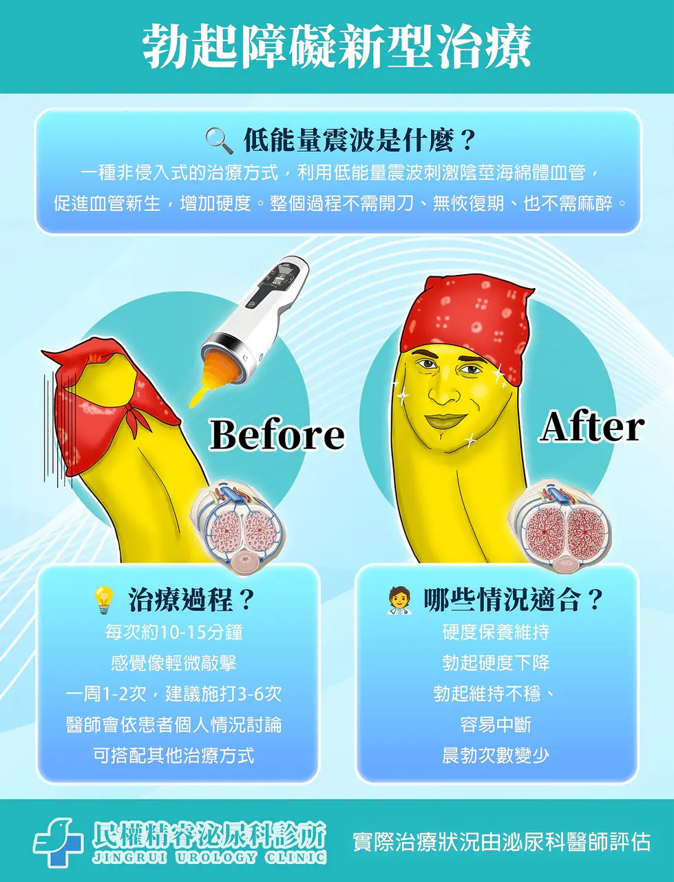 低能量震波有用嗎？震波可以保養嗎？30+男性的好朋友！硬度+++++