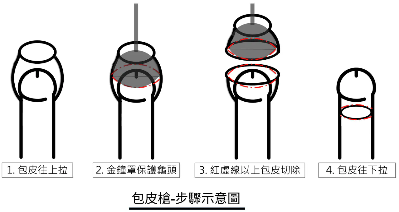 割包皮割太多會怎樣??用包皮槍比較好嗎?