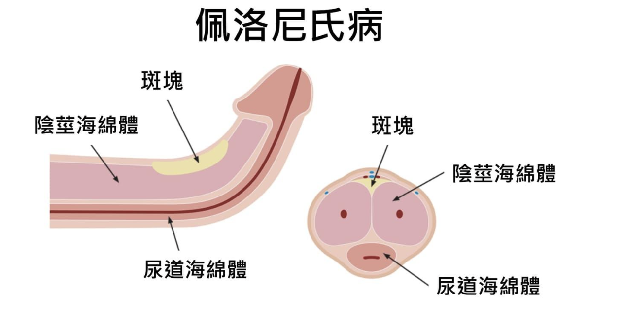 彎屌vs直屌，陰莖矯正/龍抬頭手術 介紹